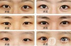 開眼角大概多少錢？開眼角價格一般是多少？