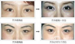 開眼角增生多久恢復(fù)?開眼角增生恢復(fù)時間？