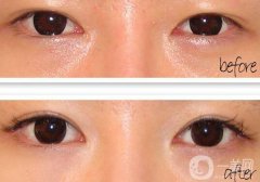 開眼角疼嗎？開眼角痛不痛？