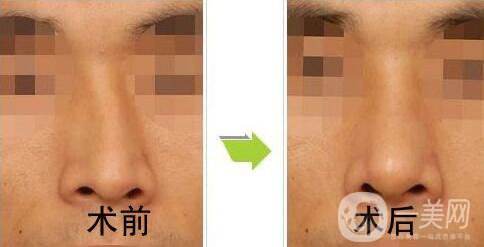 歪鼻矯正一般多少錢？歪鼻矯正手術(shù)價格詳細(xì)解析