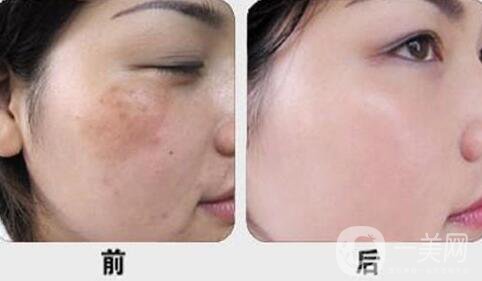 激光調(diào)節(jié)黃褐斑要多少錢？激光祛黃褐斑價格價格分析