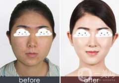 光子嫩膚果怎么樣？光子嫩膚多長(zhǎng)時(shí)間做一次？