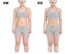 超聲波吸脂減肥果怎么樣？超聲波吸脂減肥多少錢？　　
