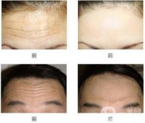 去抬頭紋好的方法？去抬頭紋那種方法好？