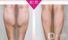 注射瘦腿果好嗎？注射瘦腿多少錢一針？