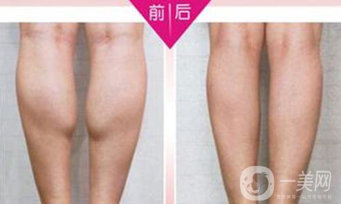 **果好嗎？*多少錢一針？