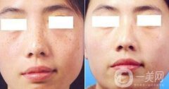 去雀斑價(jià)格 去雀斑價(jià)收費(fèi)明細(xì)說(shuō)明
