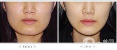 磨下頜角價(jià)格？磨下頜角多少錢？
