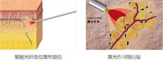 光纖溶脂減肥*果嗎?有哪些注意事項？