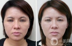 光子嫩膚大概要多少錢？光子嫩膚價格詳解
