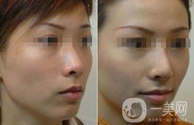 光子嫩膚大概要多少錢？光子嫩膚價格詳解