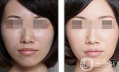 彩光嫩膚要多少錢？彩光嫩膚價格需要多少？