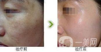 光子嫩膚調(diào)節(jié)黃褐斑*果怎么樣？去黃褐斑圖