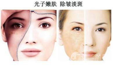 光子嫩膚如何護(hù)理？光子嫩膚的注意事項(xiàng)