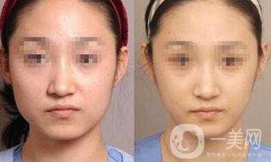 去頰脂墊要多少錢？去頰脂墊價(jià)格詳解