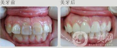 四環(huán)素牙怎么變白？四環(huán)素牙怎么辦？