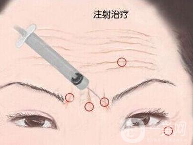 *生物除皺*果好不好？有副作用嗎？
