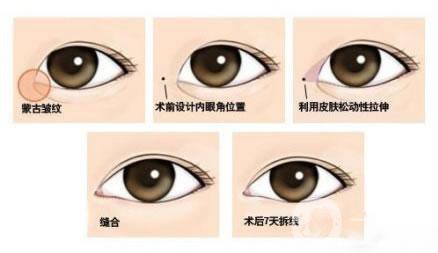 韓式開(kāi)眼角多少錢(qián)？?jī)r(jià)格很貴嗎？