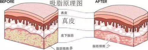 吸脂的價格一般是多少？價格差異大嗎？