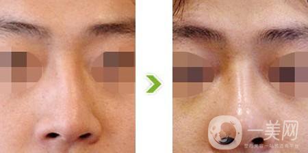 歪鼻矯正費(fèi)用大概是多少？價格影響因素有哪些？