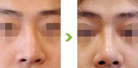 歪鼻矯正費(fèi)用大概是多少？?jī)r(jià)格影響因素有哪些？