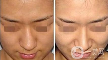 烤瓷牙有哪些種類？多久可以恢復(fù)？