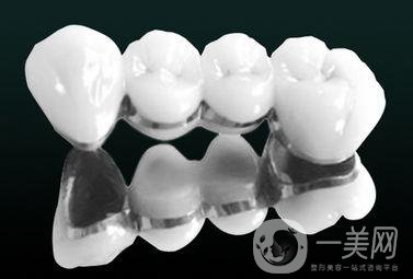烤瓷牙有哪些種類？多久可以恢復(fù)？