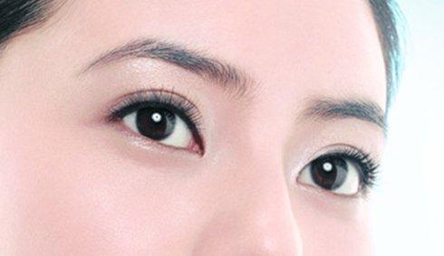 焊接雙眼皮是什么？手術(shù)后多久能好？