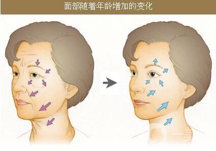 生物除皺的價格是多少 生物除皺收費明細