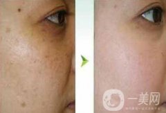 去蝴蝶斑用什么方法好？蝴蝶斑調(diào)節(jié)方法詳細(xì)介紹