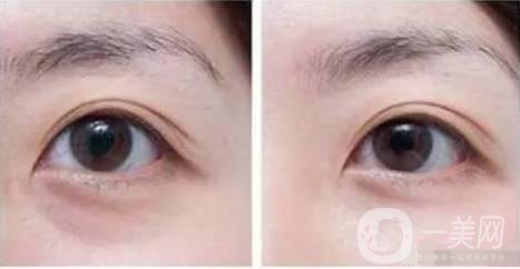 自體脂肪填充眼眶注意事項(xiàng)主要有哪些？