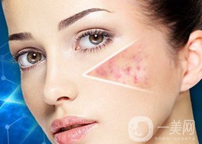 像素激光去痘坑*果怎么樣？怎樣很好的調(diào)節(jié)*果？