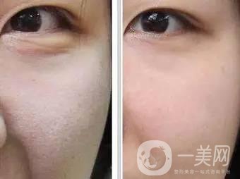 果酸換膚后注意事項盤點大揭秘，該怎么做？
