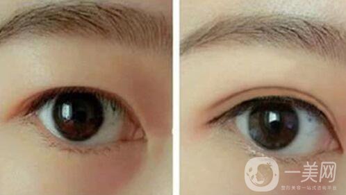 韓式三點雙眼皮是埋線還是割？手術*果怎么樣