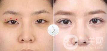 韓式三點雙眼皮是埋線還是割？手術*果怎么樣