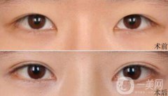 高分子埋線是*的嗎？可以維持幾年？