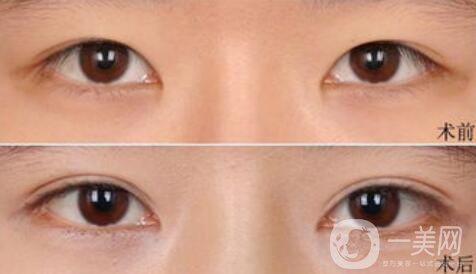 高分子埋線是*的嗎？可以維持幾年？