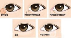 開眼角果有哪些、開眼角手術(shù)的果怎么樣？