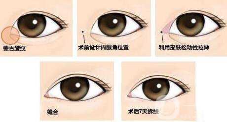 開眼角*果有哪些、開眼角手術(shù)的*果怎么樣？