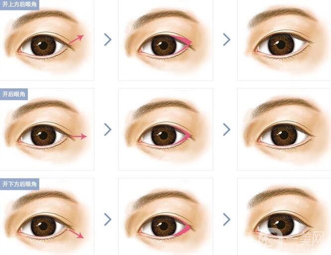 開眼角*果有哪些、開眼角手術(shù)的*果怎么樣？