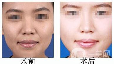 自體脂肪豐鼻唇溝有什么優(yōu)勢(shì)？*果怎么樣呢？