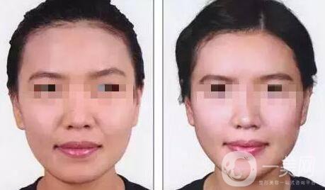 自體脂肪豐鼻唇溝有什么優(yōu)勢(shì)？*果怎么樣呢？