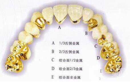 黃金烤瓷牙多少錢一顆？黃金烤瓷牙價格詳解