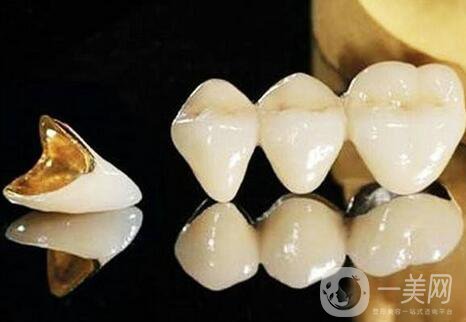 黃金烤瓷牙多少錢一顆？黃金烤瓷牙價格詳解