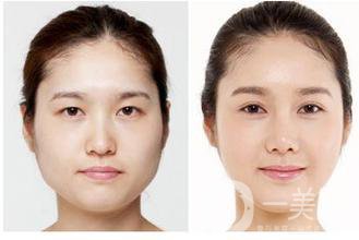 生物焊接雙眼皮是什么？有什么特點(diǎn)？