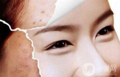 光子嫩膚能去痘印嗎、光子嫩膚去痘印果怎么樣？
