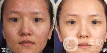光子嫩膚能去痘印嗎、光子嫩膚去痘印*果怎么樣？