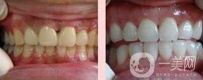 四環(huán)素牙如何變白、四環(huán)素牙怎么調(diào)節(jié)？