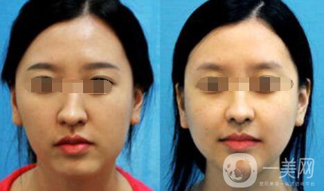 歪鼻矯正需要多少錢、歪鼻矯正術(shù)的價格詳解
