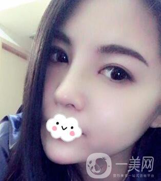 *隆鼻價(jià)格 *隆鼻需要多少錢